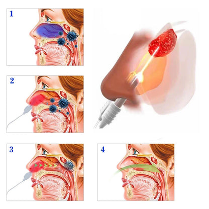 ClearBreathe Laser Therapy Device