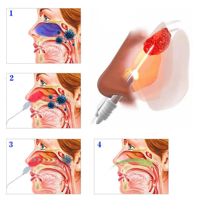 ClearBreathe Laser Therapy Device